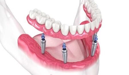 Choosing Overdenture Attachments in Muswell Hill