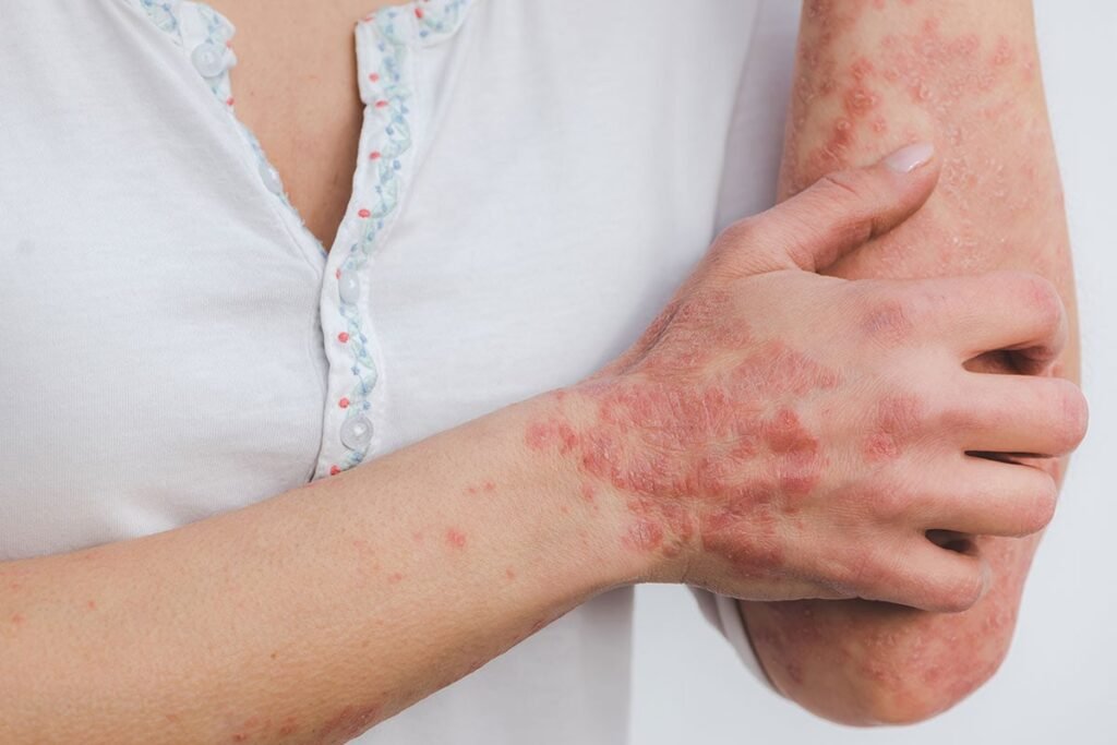 Psoriasis Treatment in Pune