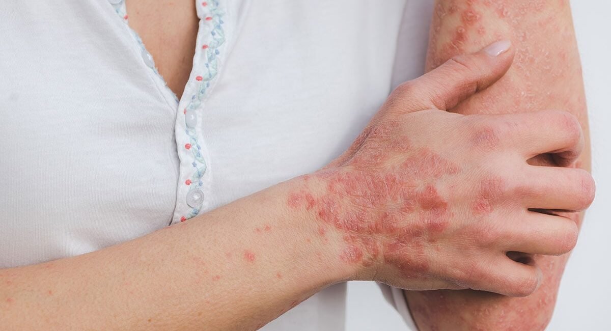 Psoriasis Treatment in Pune
