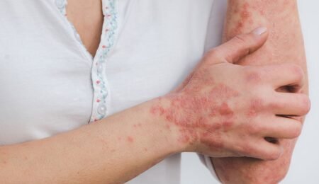 Psoriasis Treatment in Pune