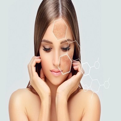 Melasma Treatment in Islamabad