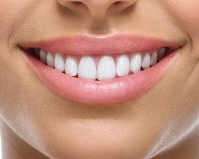 teeth-whitening-la-mirada-CA