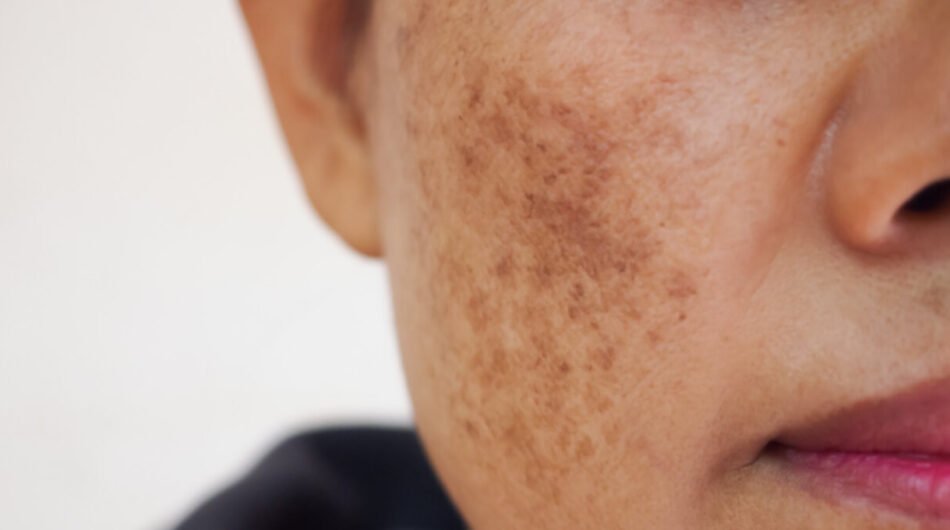 Melasma-Treatment-in-Islamabadd