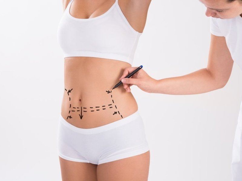 Tummy Tuck in Islamabad