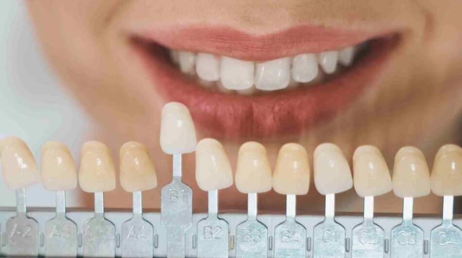 Composite-Veneers