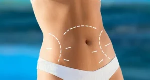 Liposuction-and-Tummy-Tuck-in-Riyadh-4