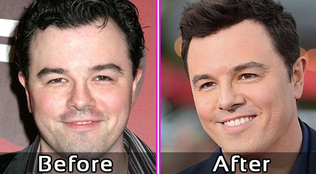 Seth-MacFarlance-Plastic-Surgery-Photos-Before