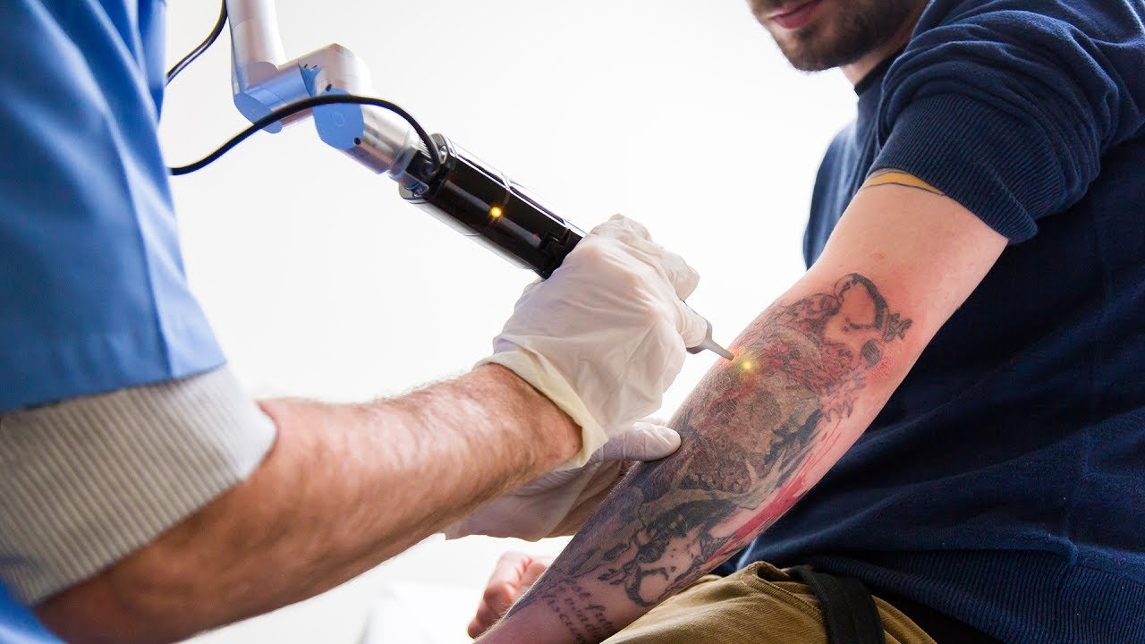 Tattoo Removal in Islamabad