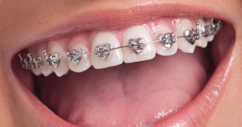 Teeth-Braces