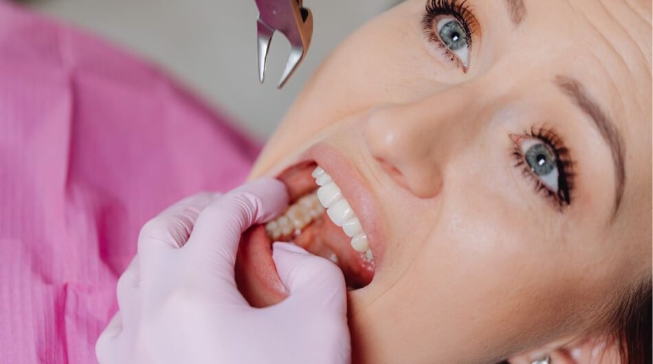 Tooth-Removal-in-Dubai