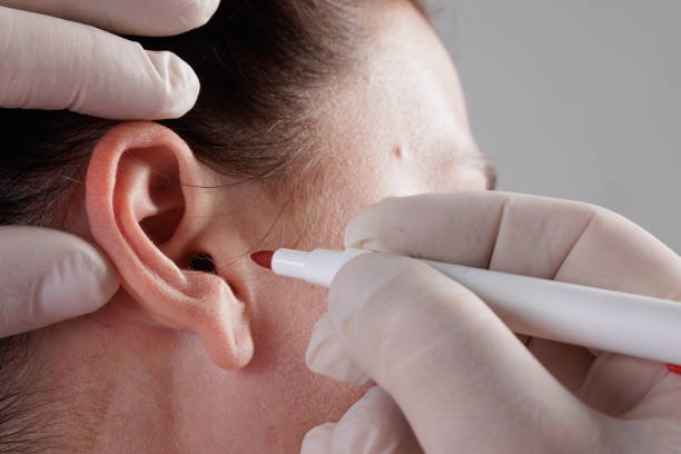 Ear Reshaping Surgery in Riyadh