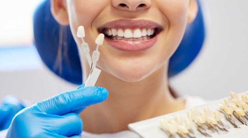 Best-Composite-Veneers