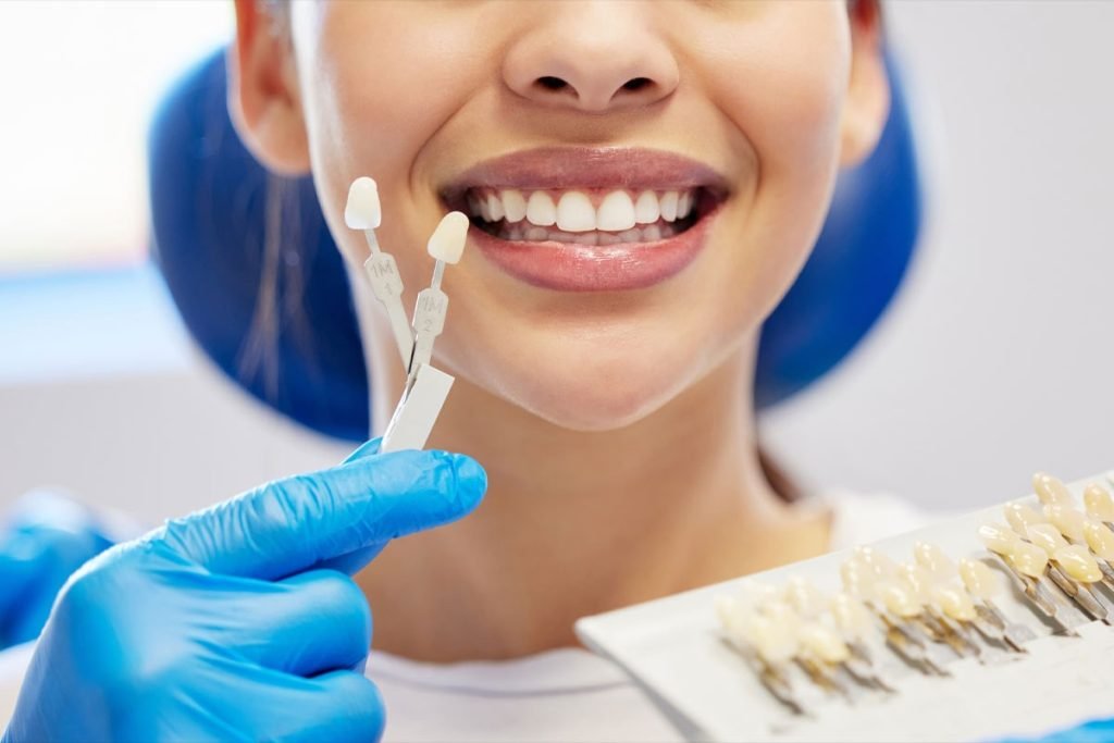 Best Composite Veneers