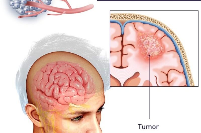 Brain-Tumor-Surgery