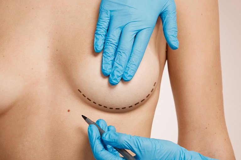 Breast-Reduction-Surgery-in-Riyadh-4-1