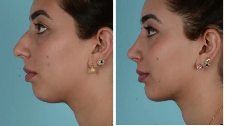Chin-Reduction-Surgery-Riyadh52