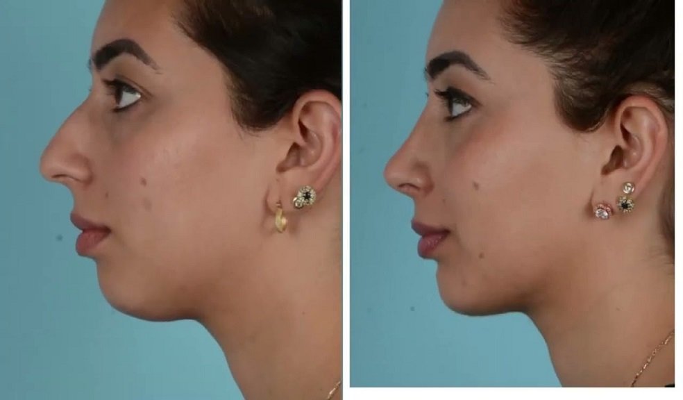 عملية تصغير الذقن في الرياض