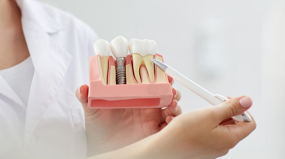 Dental-implants-Dubai