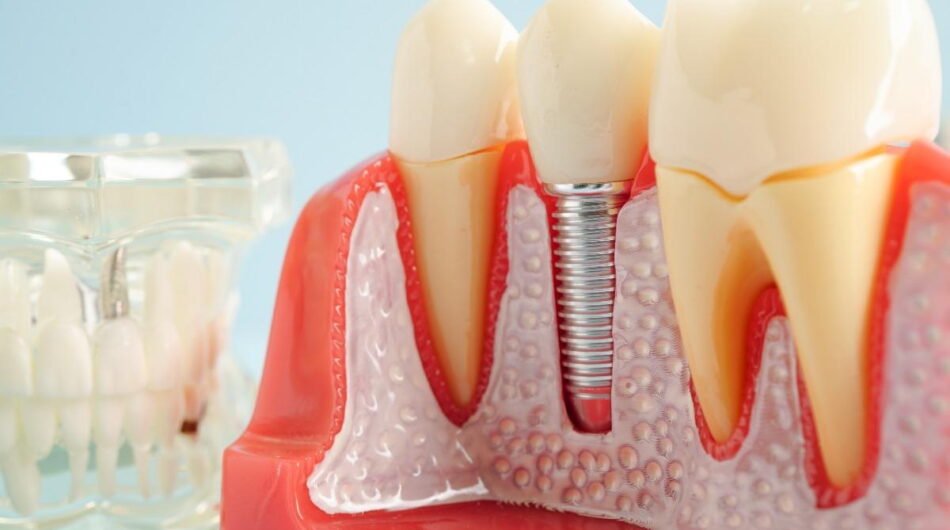 Dental-implants-surgery
