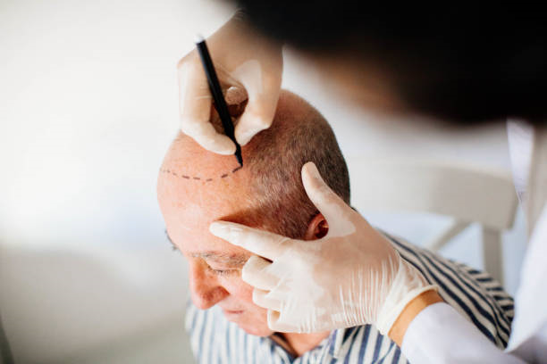 Hair-Transplant-in-Riyadh-8