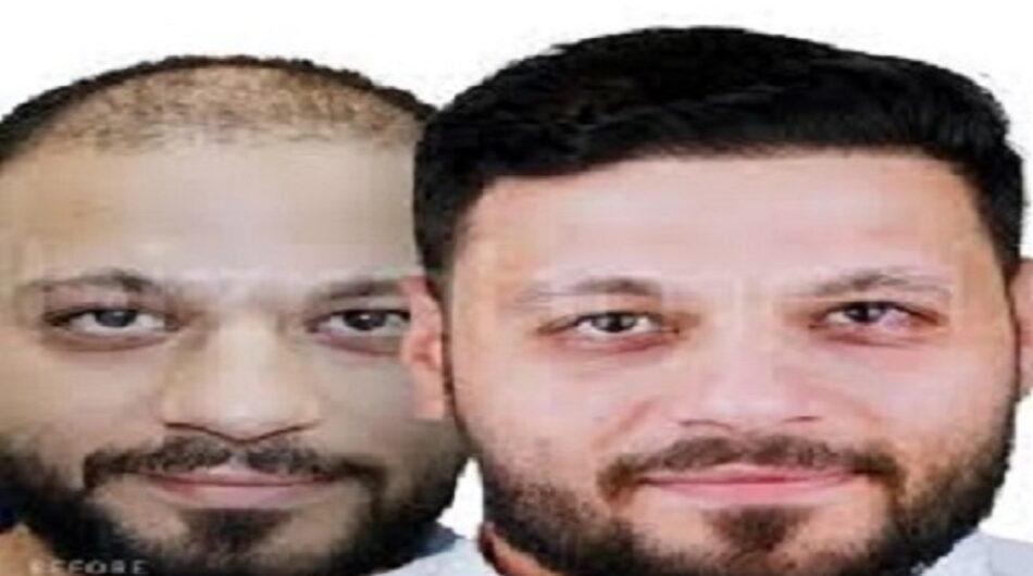 Hair-Transplant-inRiyadh42