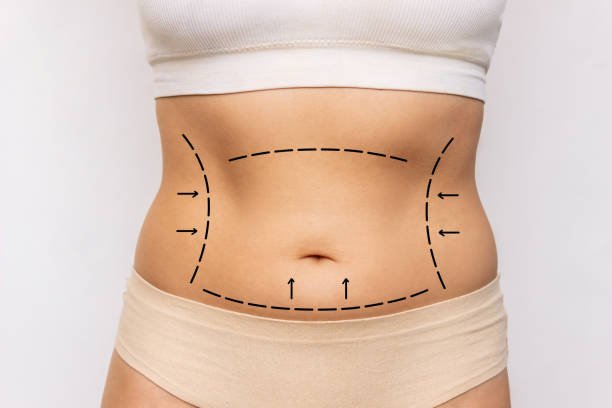 Lipo Abdonminoplasty in Riyadh