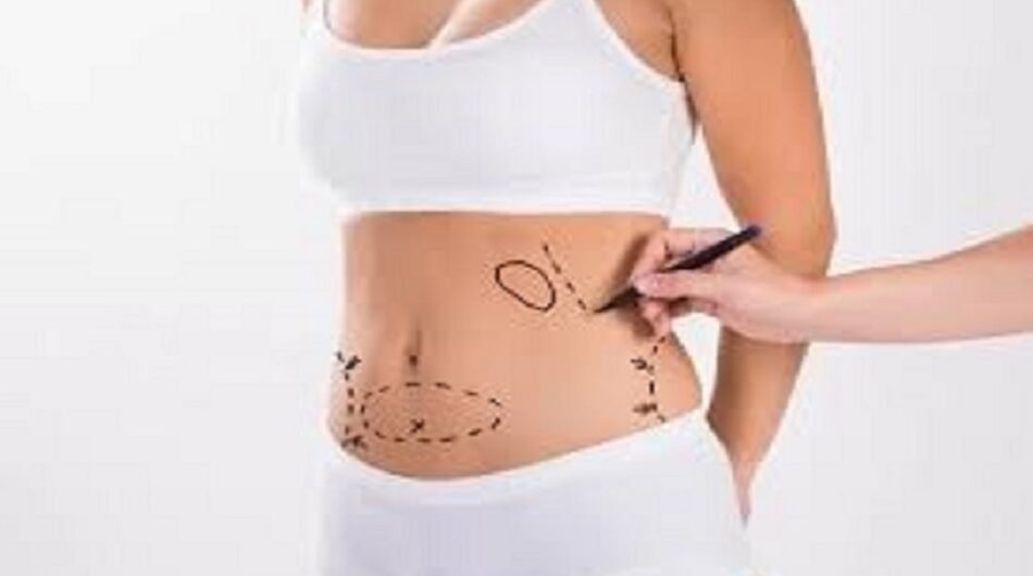 Liposuction-Dubaiiii121