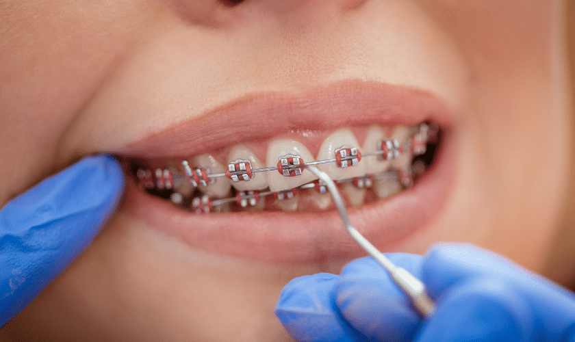 Metal-Braces-Treatment