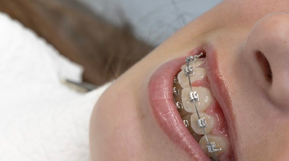 Teeth-Braces-in-Dubai
