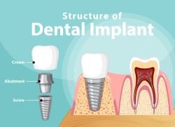 affordable-dental-implants