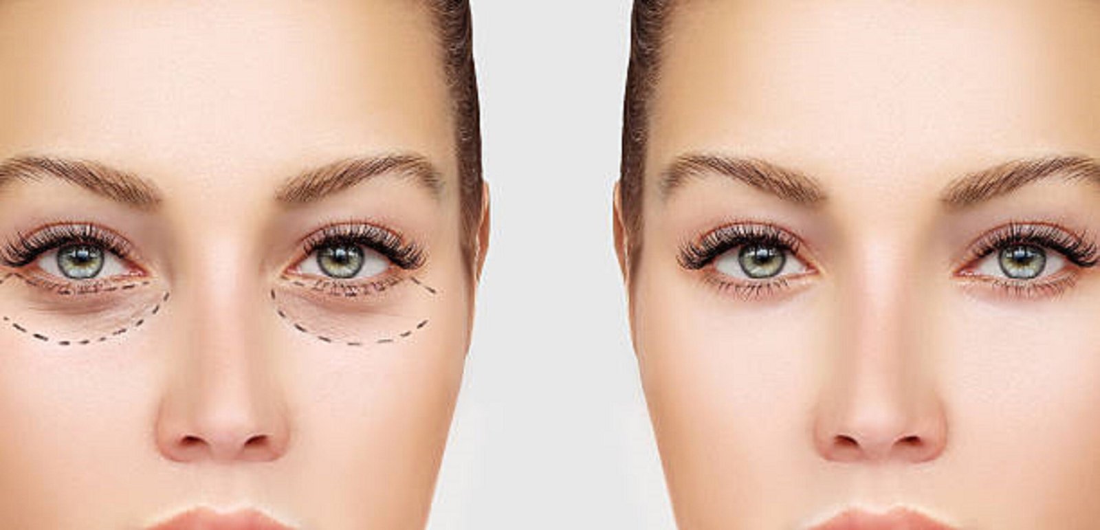 EyeLid Surgery in Riyadh