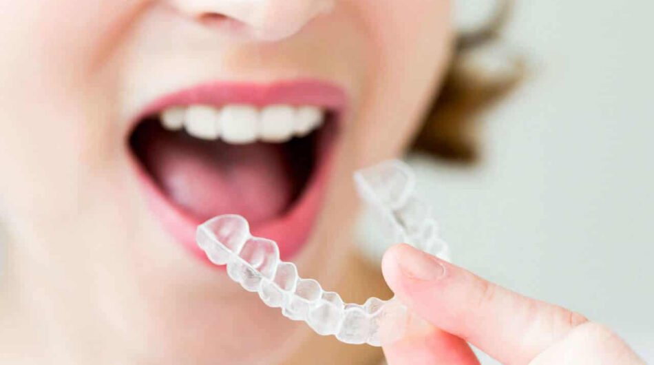 Best-Aligners-in-Dubai