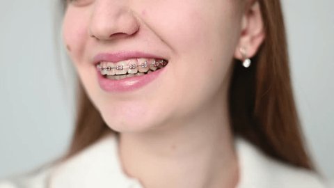 Best-Dental-Braces-Dubai