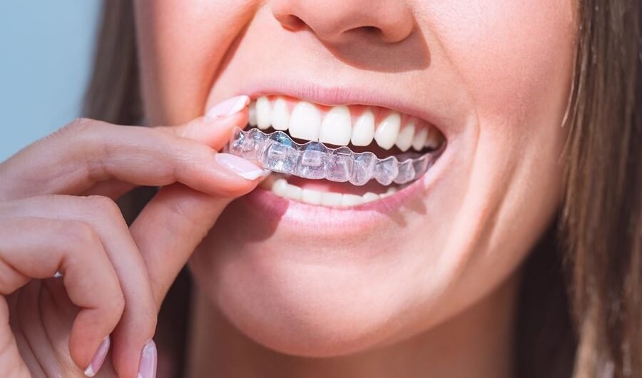 Clear-aligners