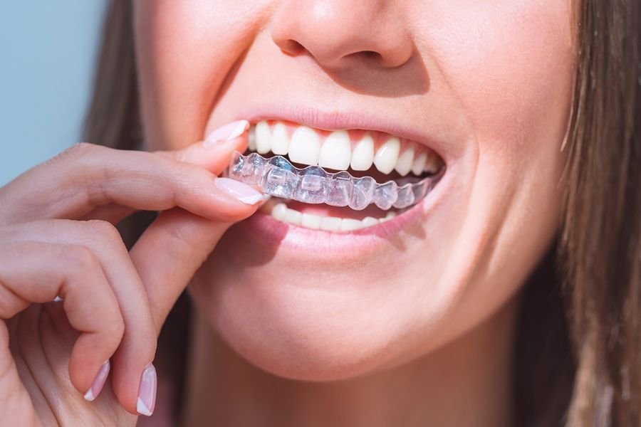 Clear aligners
