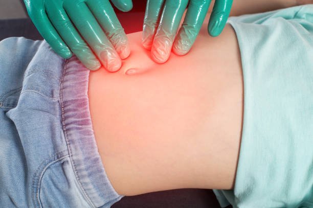 Cost of hernia surgery in Riyadh