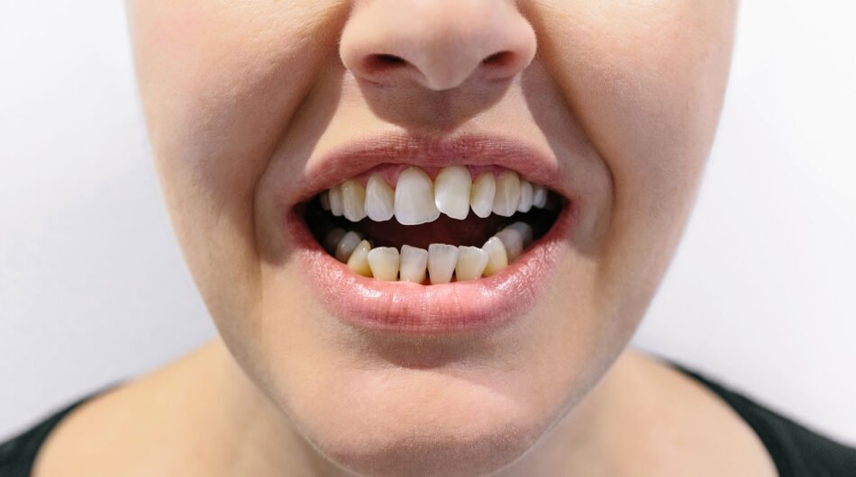 Crowded-Teeth-Treatment-In-Dubai