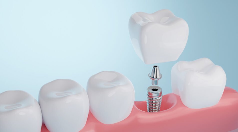 Dental-Implants-Dubai-Cost