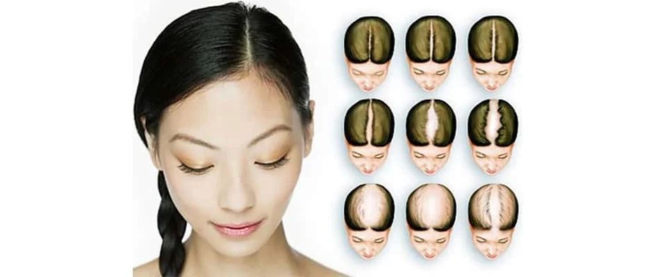 Esthetic-Hair-Turkey-Female-Hair-Transplant-1