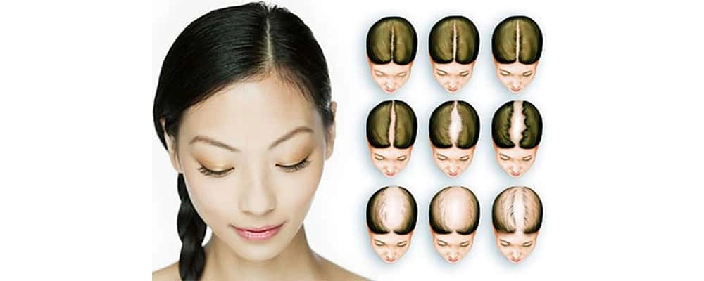 Hair Transplant Cost in Riyadh