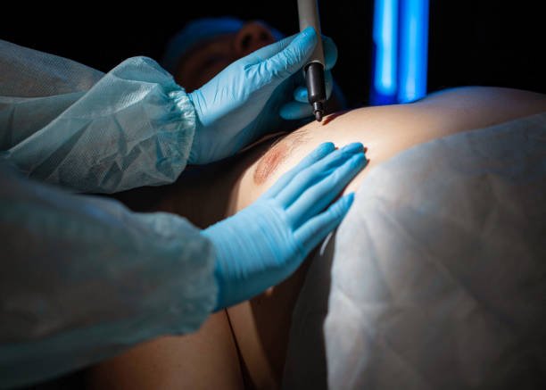 Gynecomastia Surgery in Riyadh