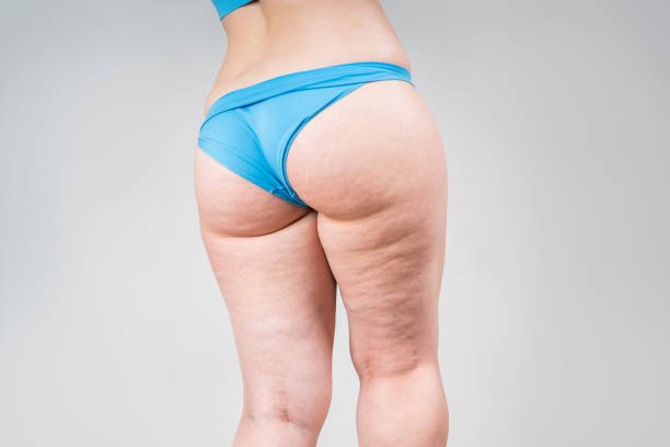Lipedema treatment in Riyadh