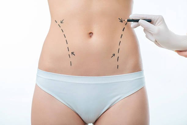 Liposuction-surgery-in-Riyadh-21