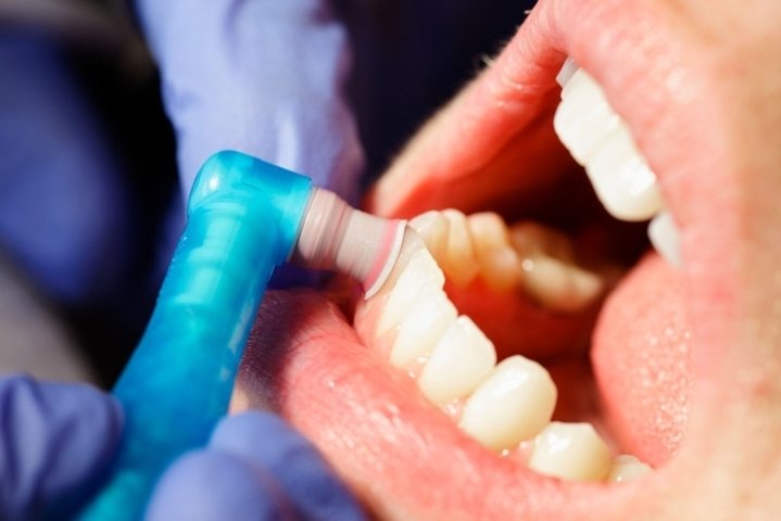Teeth-Polishing-Scaling