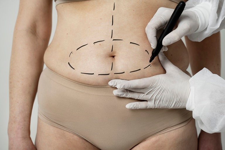 Tummy Tuck surgery in Riyadh