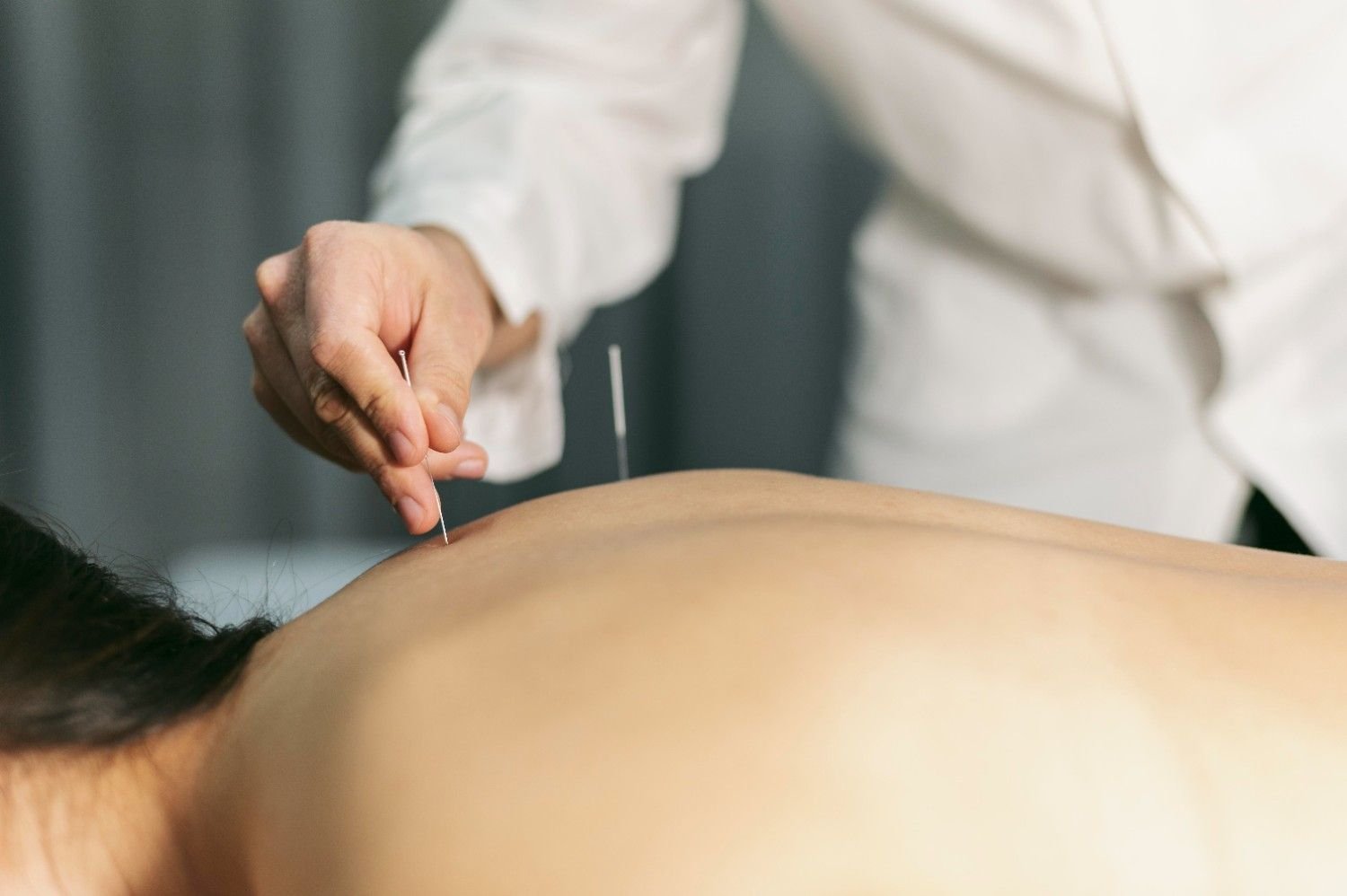 Relieve Stress with Acupuncture for Anxiety in New York