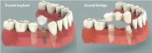 dental_implants_vs_bridges_2015-300×105.jpg