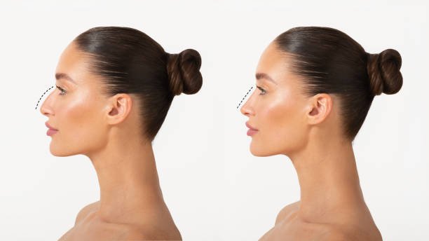 Rhinoplasty cost in Saudi Arabia