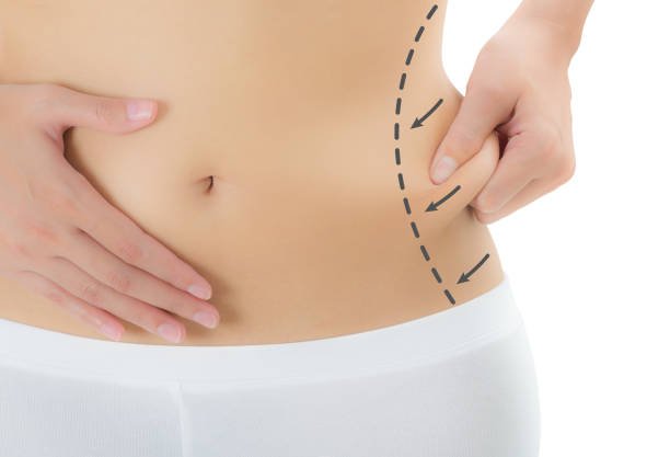 Liposuction in Riyadh