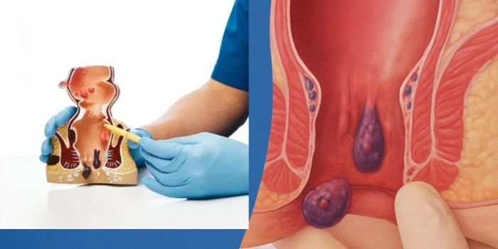 Advanced-Laser-Treatments-by-the-Best-Piles-Doctor-in-Delhi